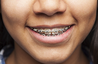 Brackets autoligables