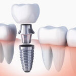 Implantes-dentales