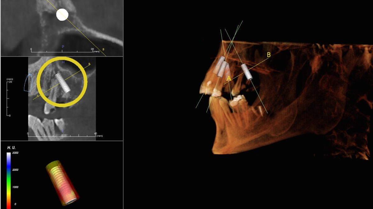 ¿Te parece caro un implante dental?