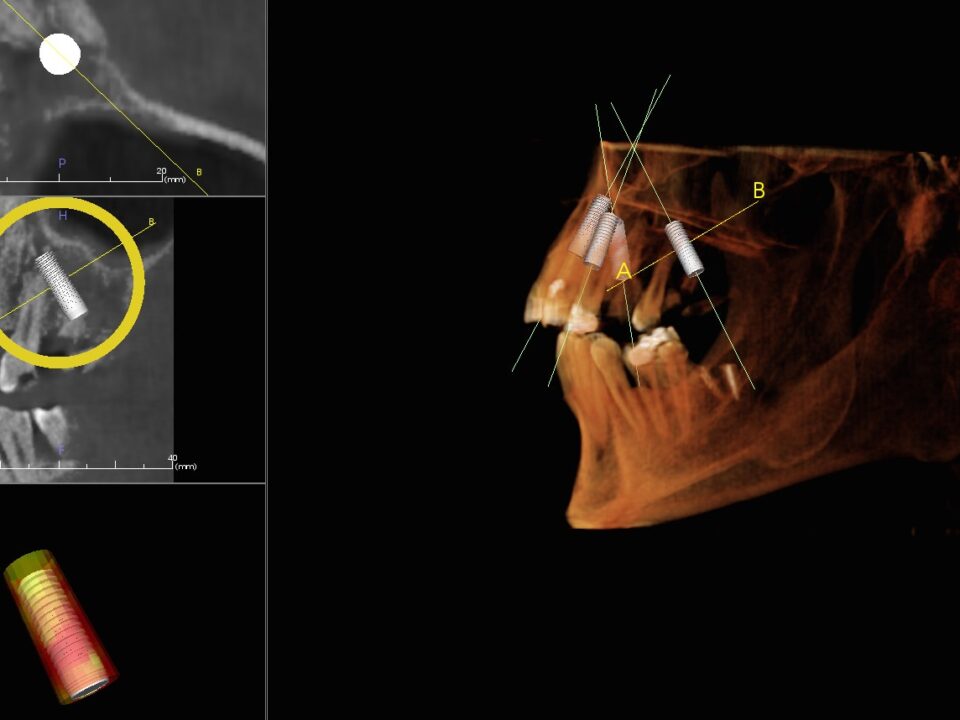 ¿Te parece caro un implante dental?