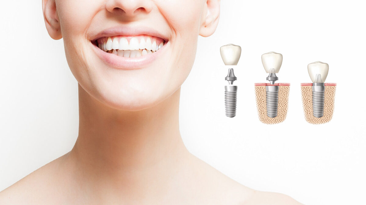 implantes dentales tarancon