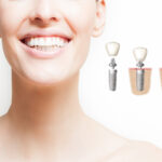 implantes dentales tarancon