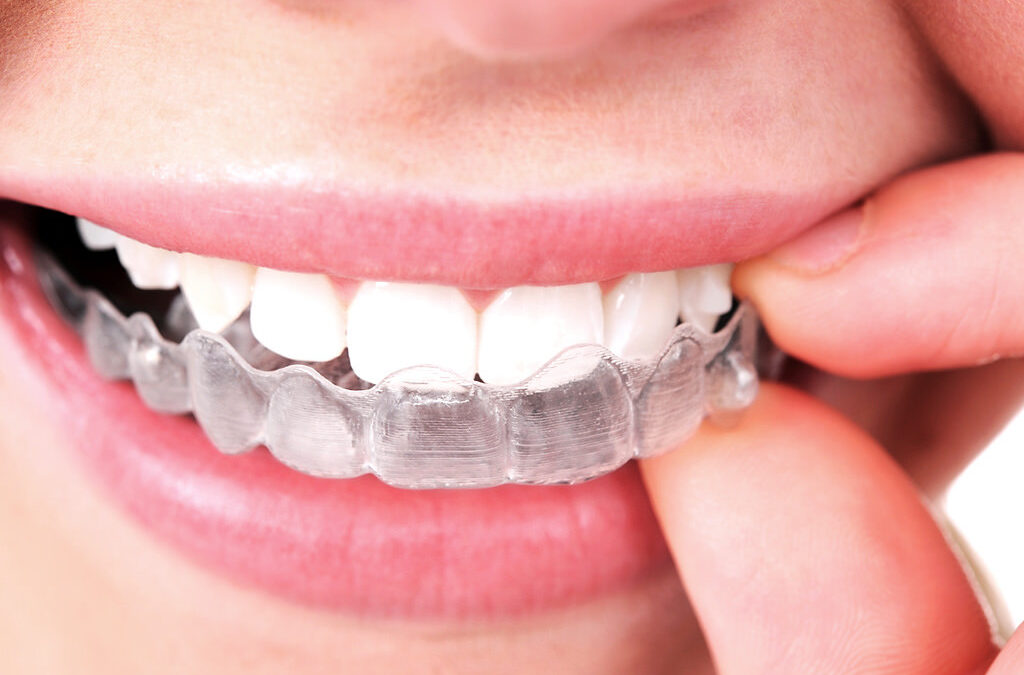 ¿Quieres conocer las ventajas del Invisalign?