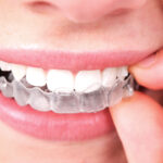 ¿Quieres conocer las ventajas del Invisalign?