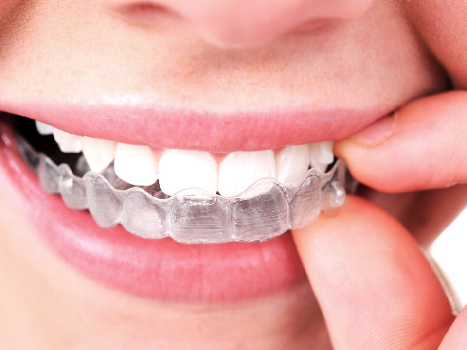 ¿Quieres conocer las ventajas del Invisalign?