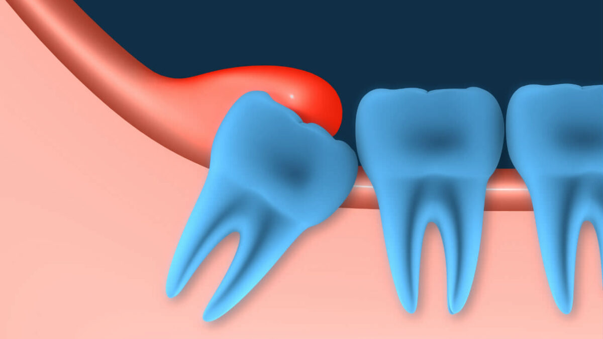 La pericoronitis es una infección de las encías