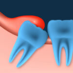 La pericoronitis es una infección de las encías