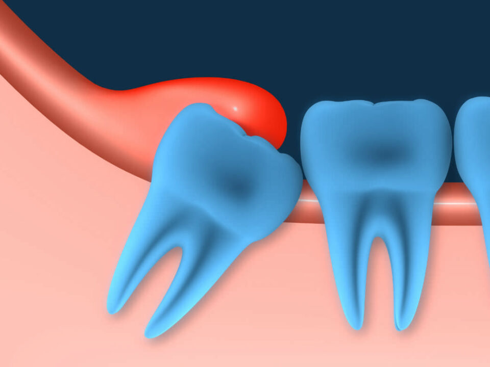 La pericoronitis es una infección de las encías