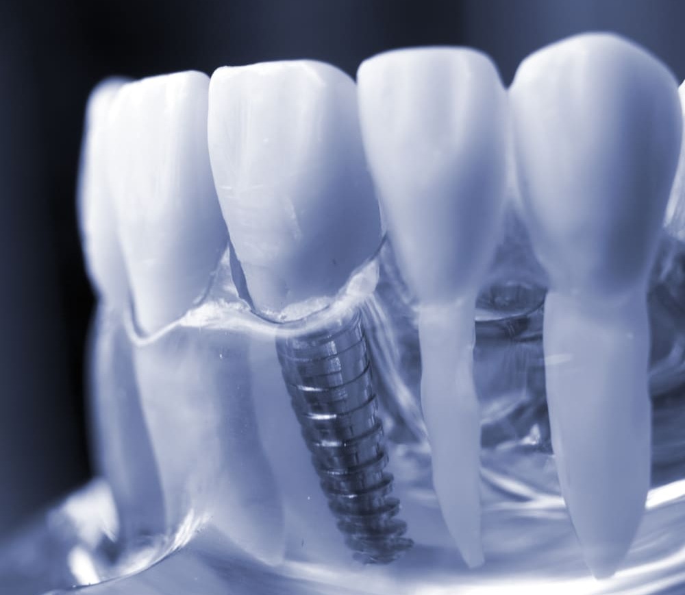 implantes dentales