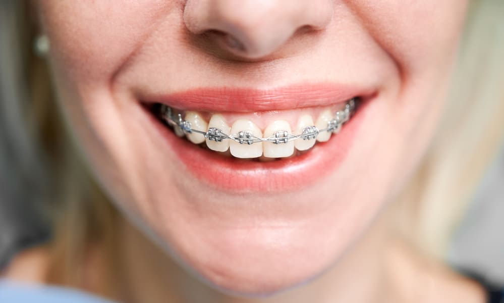 Ortodoncia Sabadell